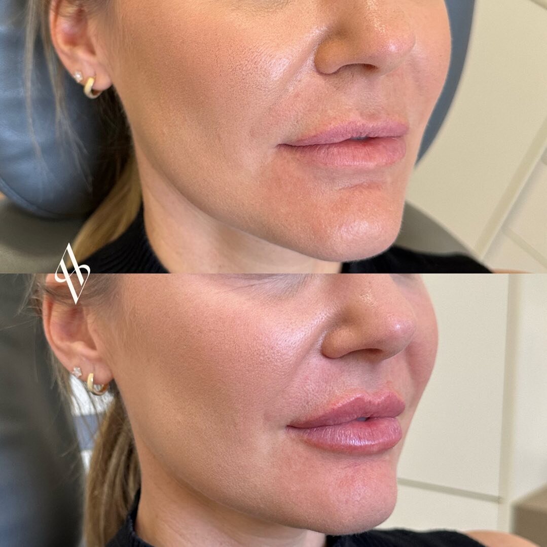 A Flat side profile, increase height and crisp definition ✨
My ultimate trio when it comes to lip filler 🤍🤎

Photos immediately before and after treatment.

#dermalfiller #lipfiller #cupidsbows #restylanelips #lipflip #geelongcosmetics #geelongfill