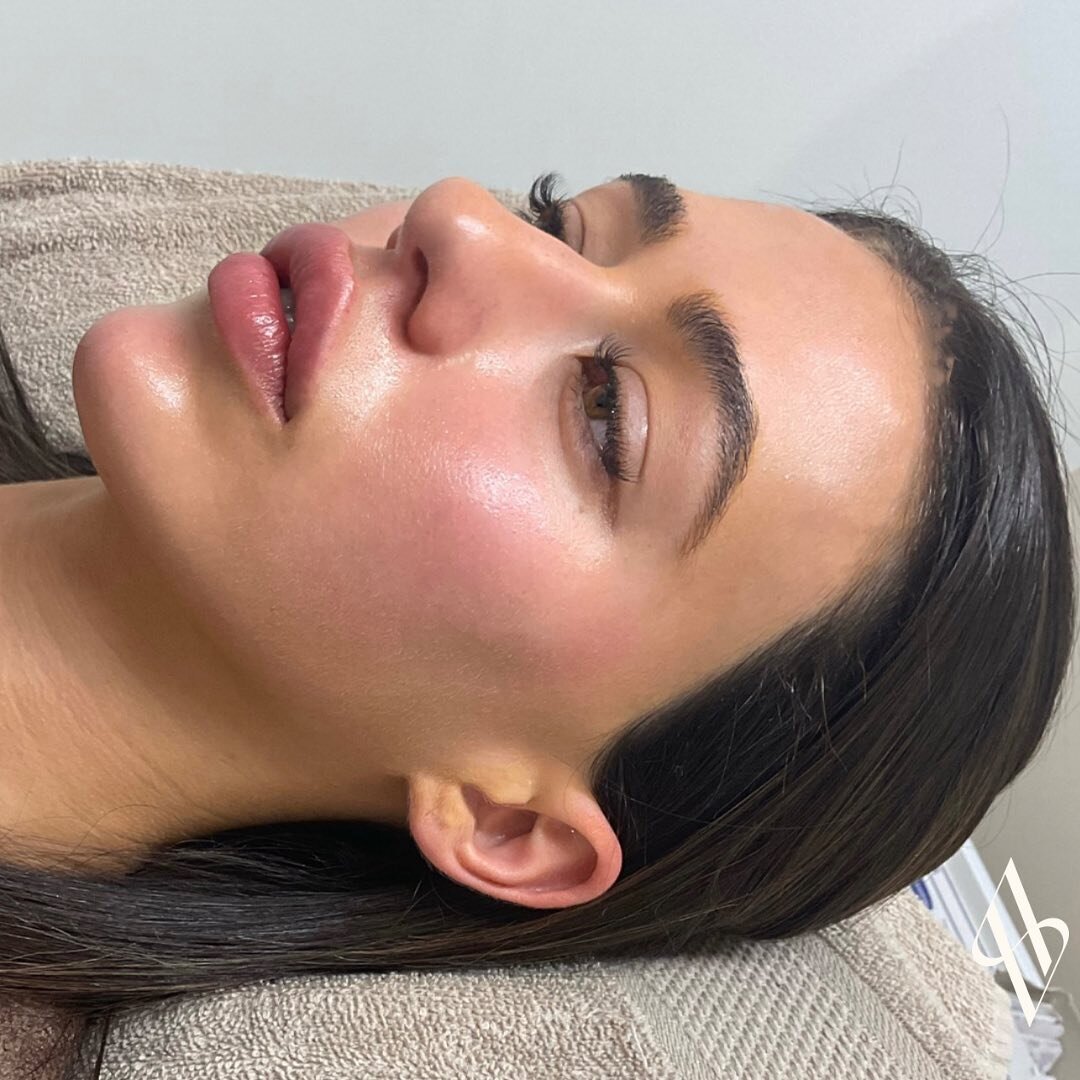 Snatched ✨

Creating a sharp side profile using dermal fillers. 

Premium fillers placed in the lateral cheeks and chin to &ldquo;stretch&rdquo; the skin enhancing her beautiful features and softening the mid and lower face. 

Photos immediately befo