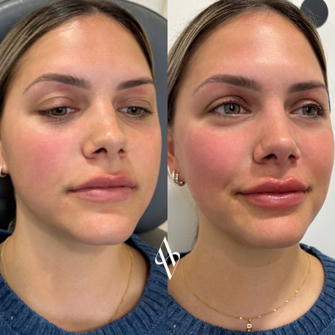 Lippies to love for the weekend ✨

Photo&rsquo;s immediately before and after injections 

#dermalfiller #lipfiller #cupidsbow #dermalfillerlips #geelongclinic #melbourneinjectables #lipflip