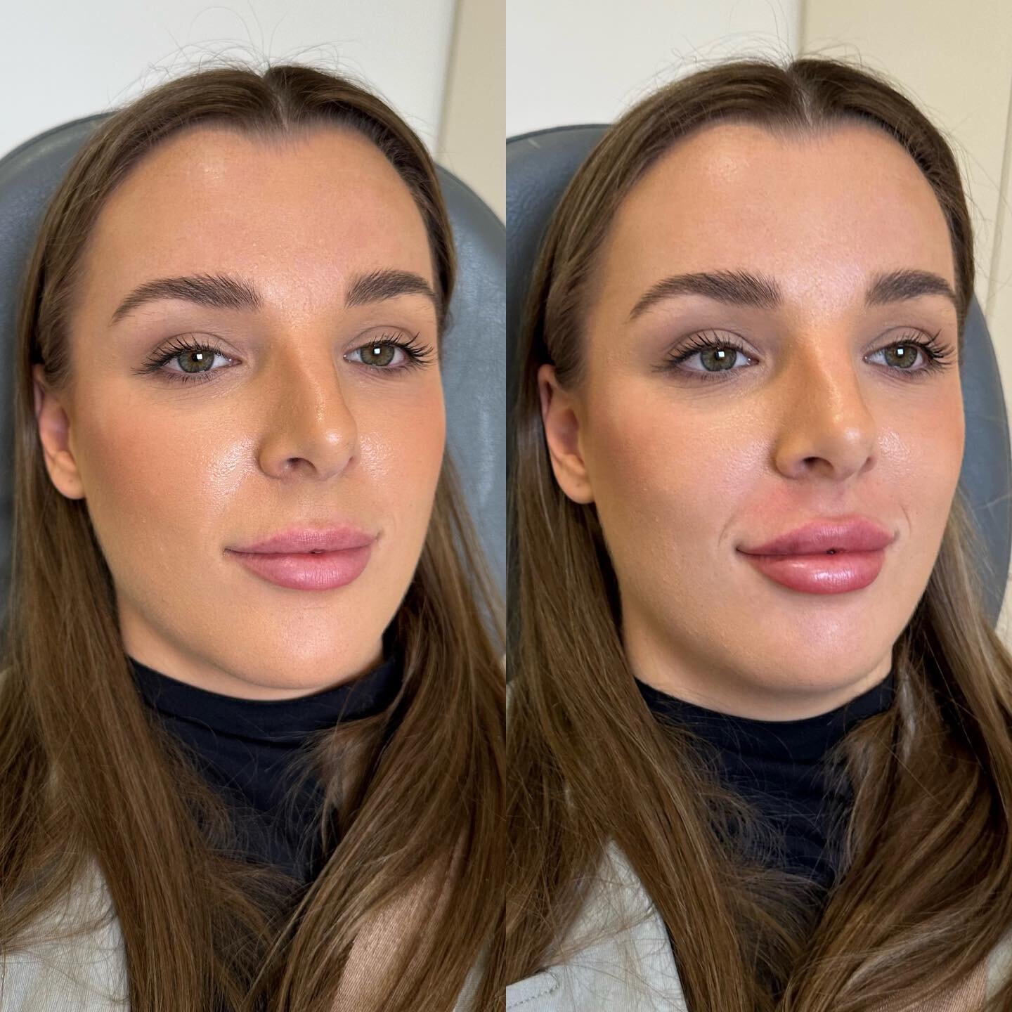Picture perfect✨🤎

If you&rsquo;re looking for a sign to get lip filler, this is it 😂 

Photos immediately before and after treatment. Swelling and bruising will last 3-4 days.