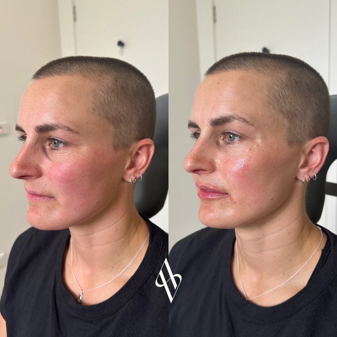 Under eye filler &amp; refresh ✨

I have been trying to get this girl in my chair for years! 

Thanks for trusting and allowing me to &ldquo; Do whatever&rdquo; , finally 🤭🤎