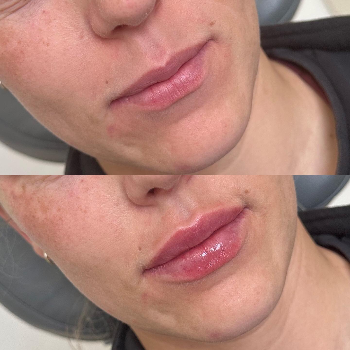 Fresh ✨

Small amounts of HA filler injected in the right places can make a world of difference, yet look so natural 🤎

Photos immediately before and after injections ✨