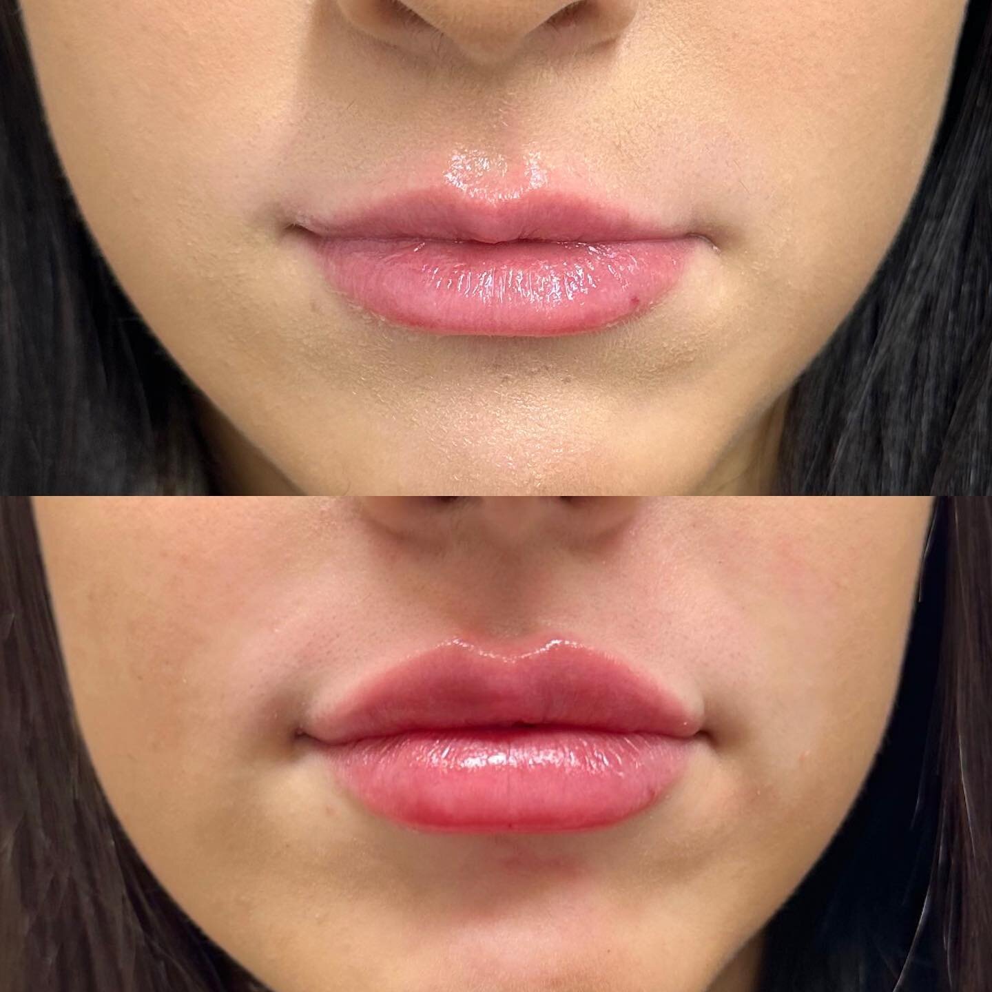 Balance ✨

So often my clients main concern is their smaller top lip. 

Dermal fillers are perfect to balance out the lips and tweak any little irregularities between them. 

Photos immediately before and after 🤎