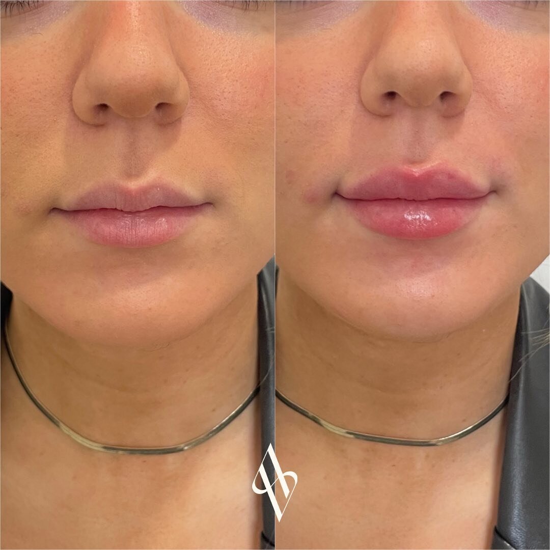 Lip filler but make it natural ✨

A small amount of HA dermal filler was used in to enhance her natural lip shape and correct the slightly M shaped lips. 

Photos are immediately before and after treatment.