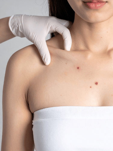 Mole Mapping Explained: Why Advanced Skin Monitoring Matters, Especially at This Time of Year