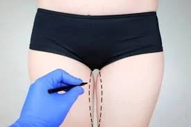Will a Thigh Lift Help with Chafing and Discomfort?