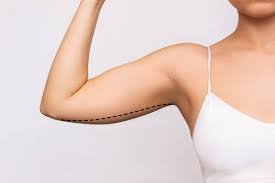 When Will I See the Final Results of My Arm Lift?
