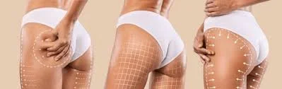 Brazilian Butt Lift vs Implants: Which Procedure Is Right for You?