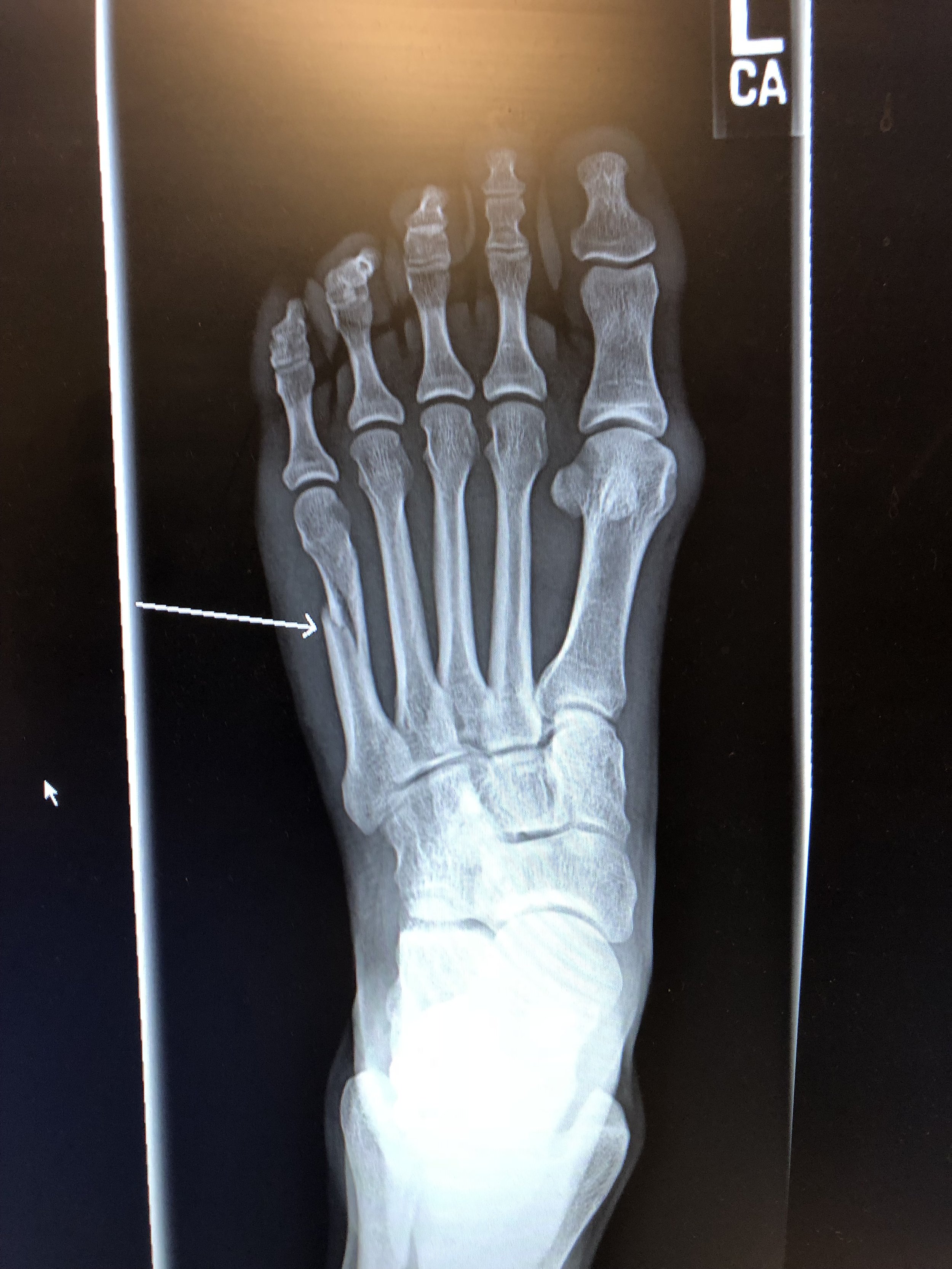 Dealing With Injuries