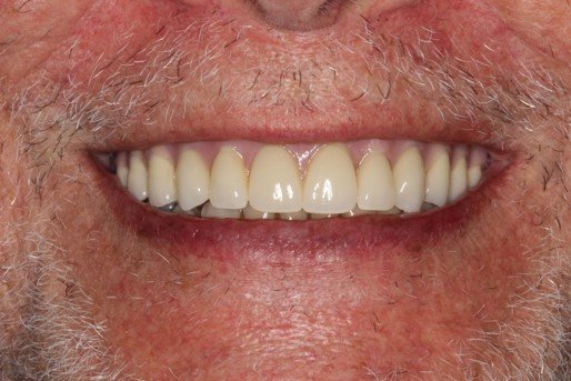 After: aligned, brighter smile