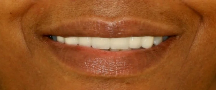 After: even, natural smile