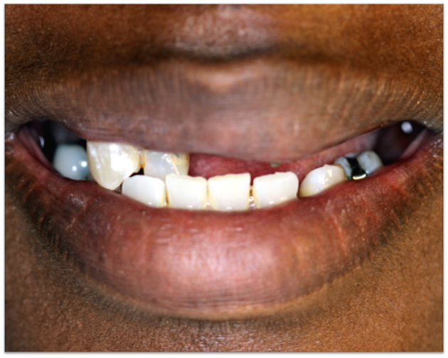 Before: damaged and missing teeth