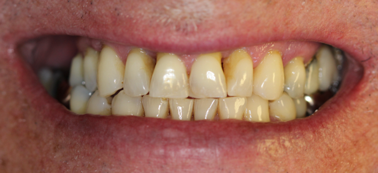 Before: yellowed, crowded teeth