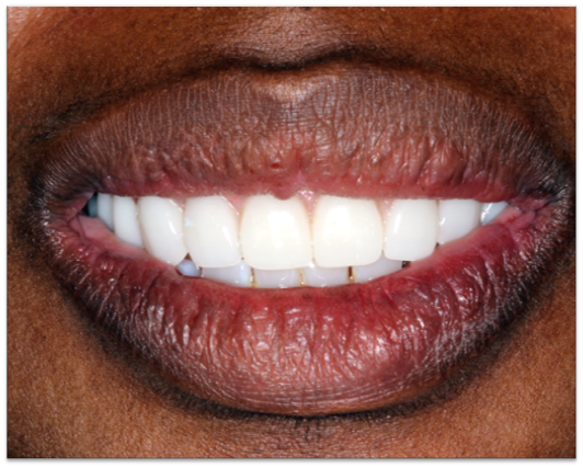 After: restored full smile