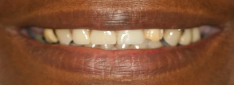 Before: worn, discolored teeth