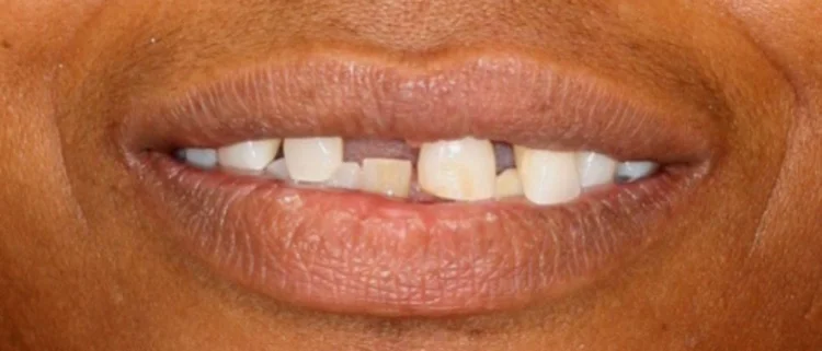 Before: chipped and uneven teeth