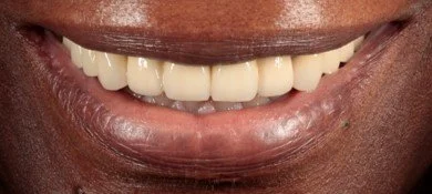 After: brighter, healthy smile