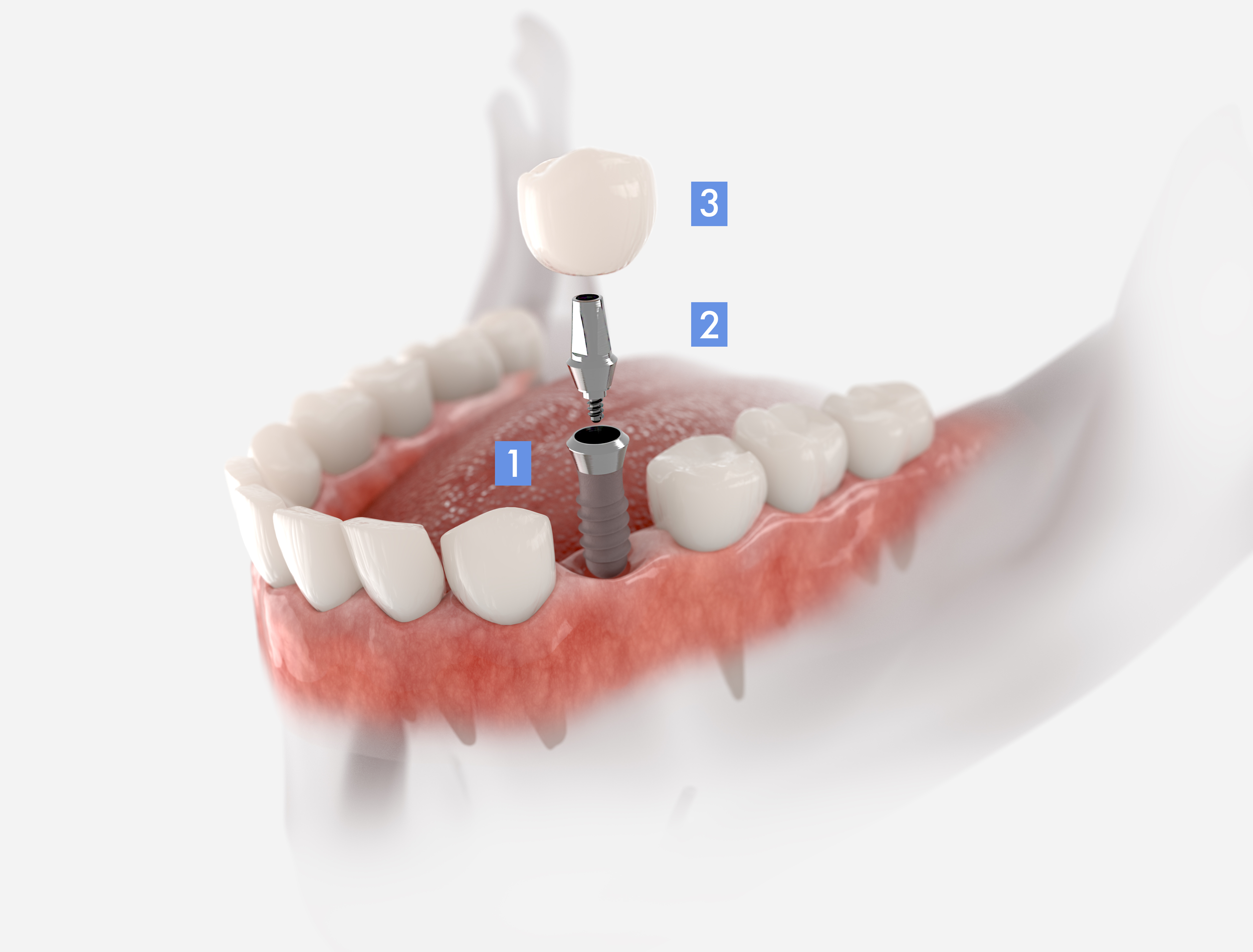 Dental implant diagram showing implant post, abutment, and crown