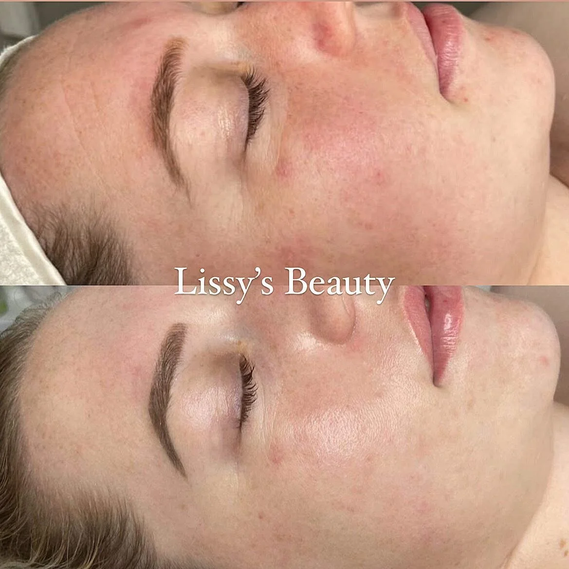 Glowing skin in the making for this beautiful client ✨ 

Tayla started her skin journey Aug 22&rsquo; with monthly Dermplaning and NanoFusion treatments to help calm her redness, even her skin tone and to give her skin the ultimate glow. 

Now we&rsq