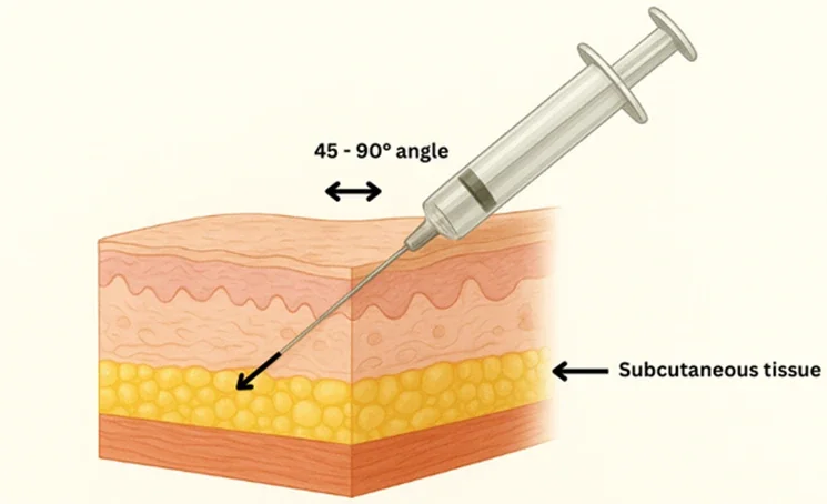 subcutaneous tissue injection diagram for glp1 weight loss injections