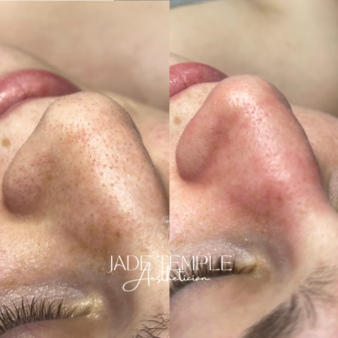 Ashtyn - blackhead extractions.png