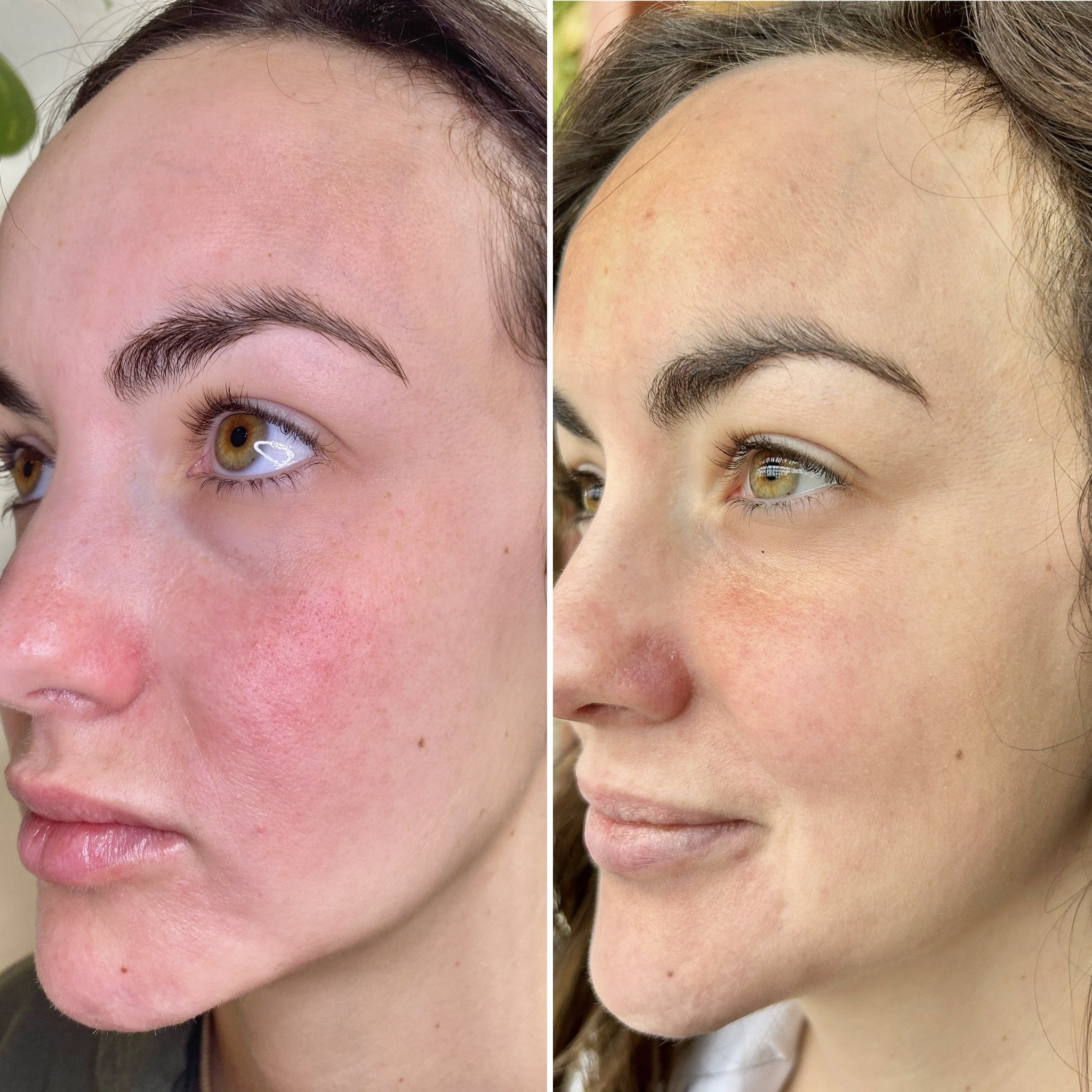 microneedling before and after