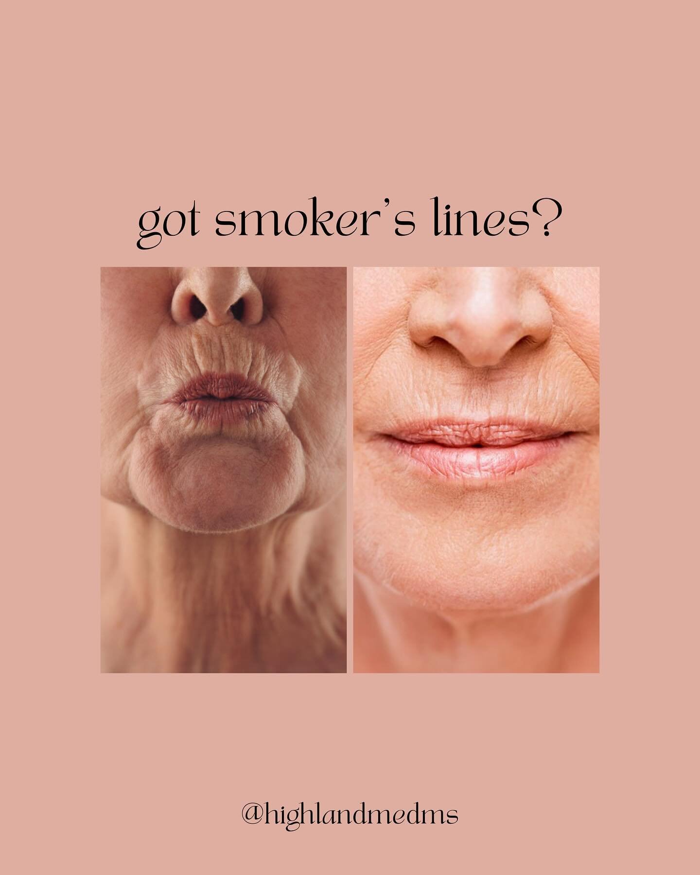 Keep your kisses, ditch the lines! 😘 Say goodbye to smoker&rsquo;s lines and hello to smooth smiles!

🔗 Link in bio to book!! 

.
.

👩🏻&zwj;⚕️Sara Courtney, DNP, FNP-BC
(@Saracourtney.np)
👩🏽&zwj;⚕️Itzel Barroso, FNP-C
(@itzelbarroso_np)
🧖🏽&zw