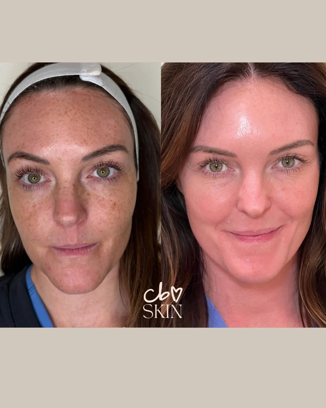 Had a little too much fun in the sun this summer? 👀

Pigment doesn&rsquo;t have to be permanent, our ZO Pigment Protocol is designed to fade sun damage, dark spots, and uneven tone so your skin can glow again.

These before + afters speak for themse