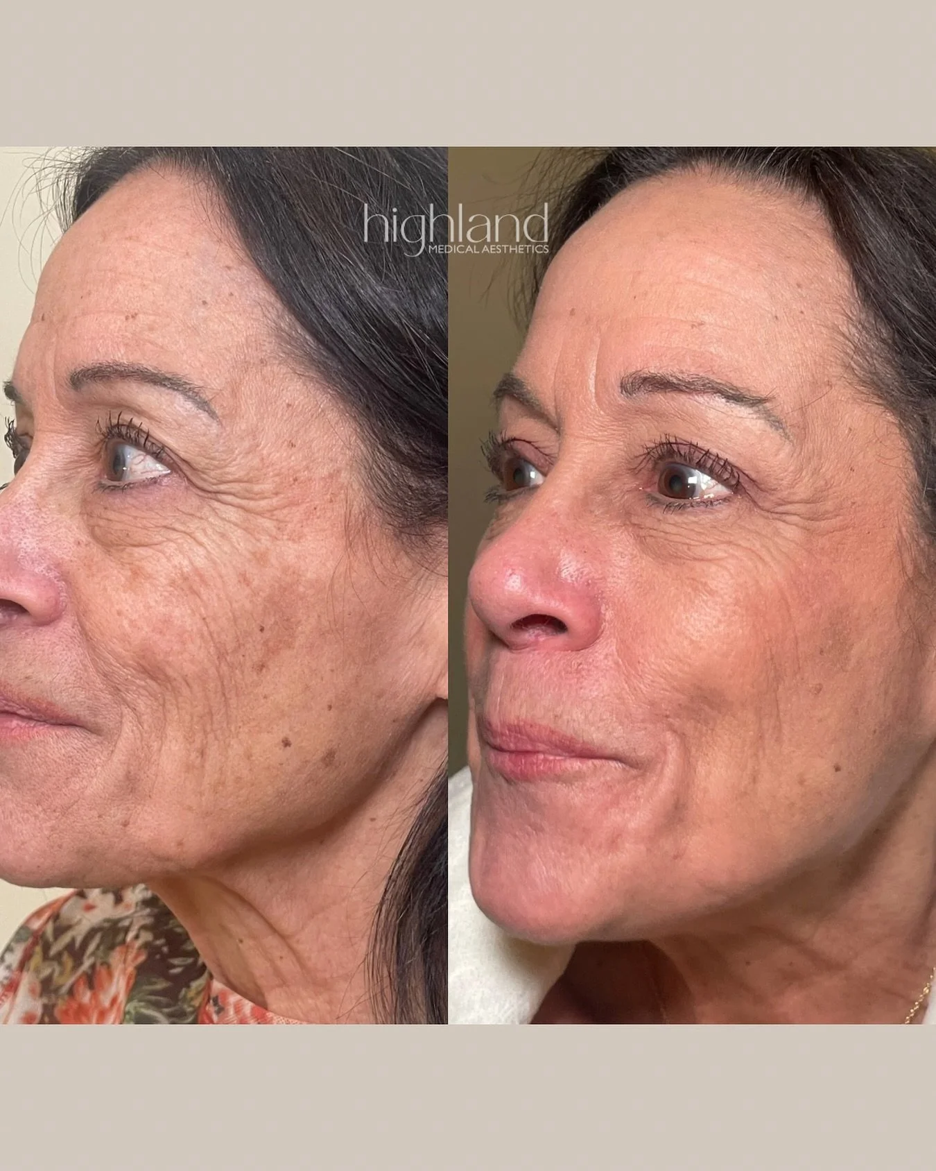 Proof that rejuvenation doesn’t always require injectables.
These Morpheus8 results were achieved by stimulating collagen and tightening the skin from within— natural, long lasting improvement you can feel and see 🤍
Buy a Morpheus 8 pa