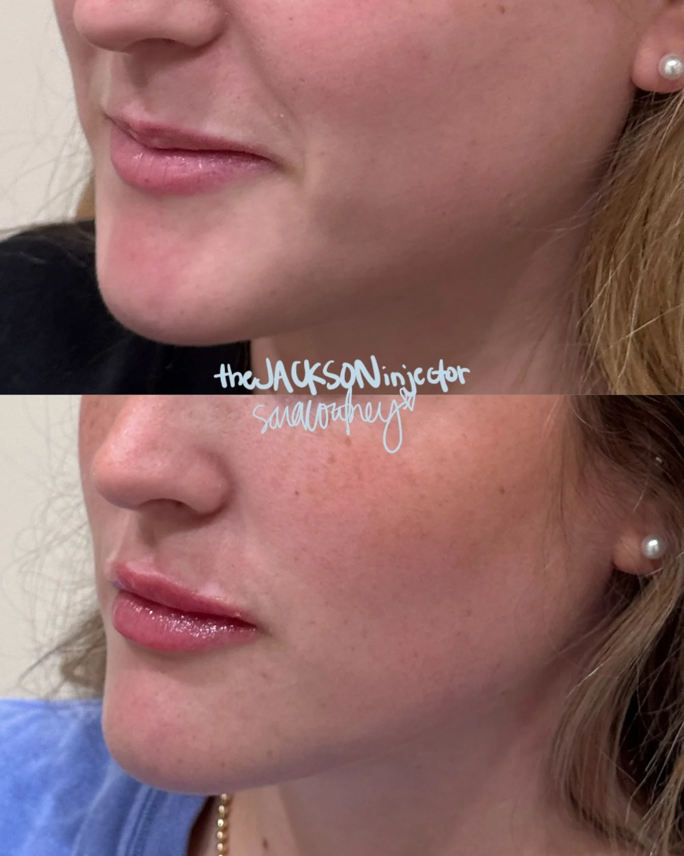 The only thing we&rsquo;re overlining in 2026 is expectations 👄

@thejacksoninjector &lsquo;s strategic lip filler is designed to enhance shape and restore volume&mdash;never overpower 👏🏻

Start the new year with the lips of your dreams &darr;
cal