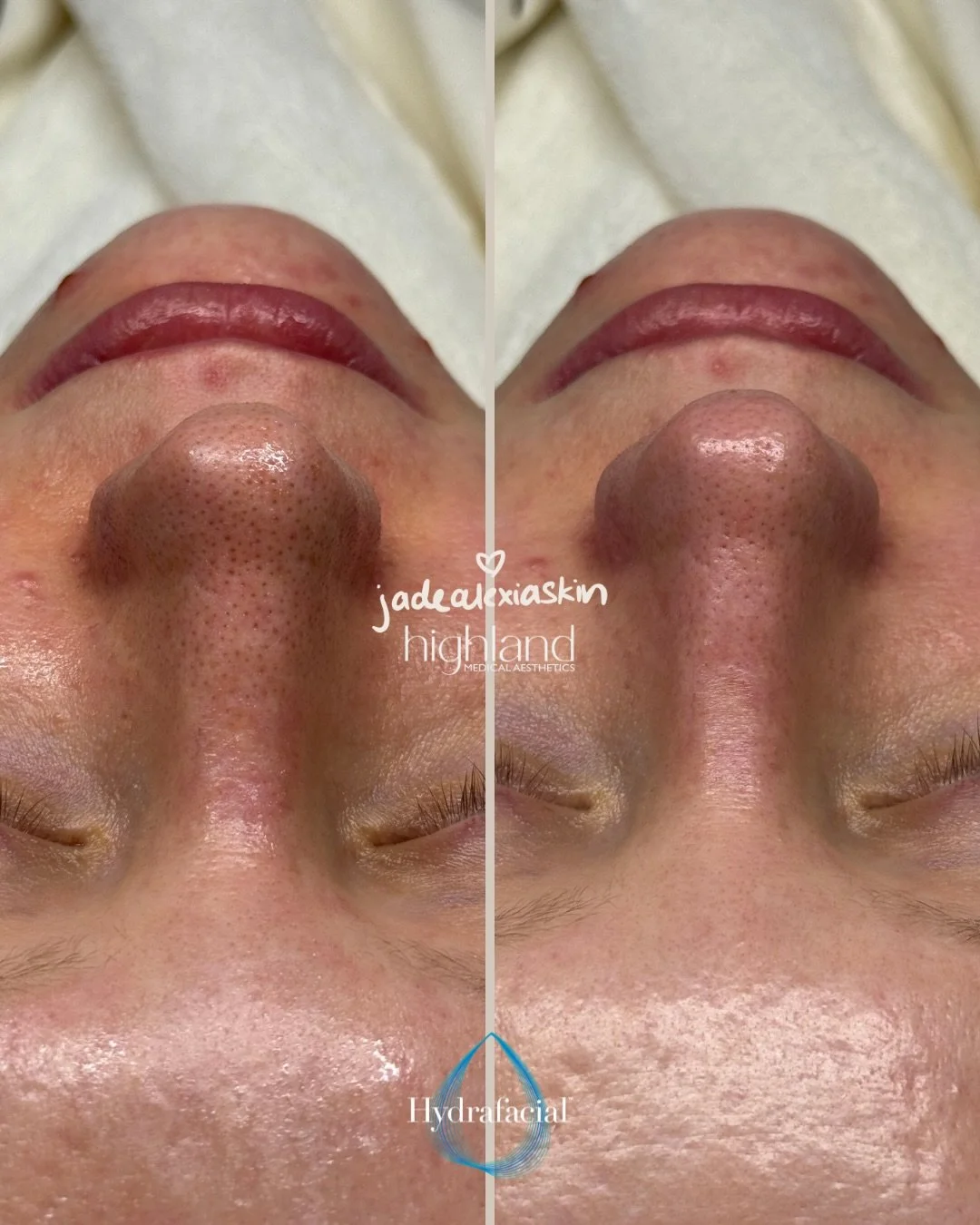 Gentle extractions > aggressive squeezing every time.

Hydrafacial clears congestion, refines pores, and leaves skin calm + glowing, never angry.

Your nose deserves better!!😉

Book your Hydrafacial treatment here ↴
📞(601)439-2436
💌 (601) 521-9