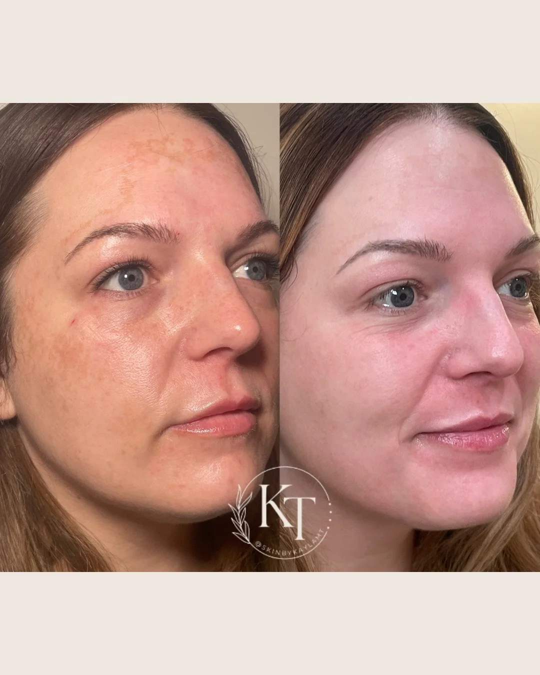 We just love seeing that sun damage and pigmentation fade away😍😍

@skinbykaylamt absolutely slayed this pigment protocol 🔥 and she can slay yours too!! 

Book your free consultation here ↴
📞(601)439-2436
💌 (601) 521-9731
Visit our link in bio to