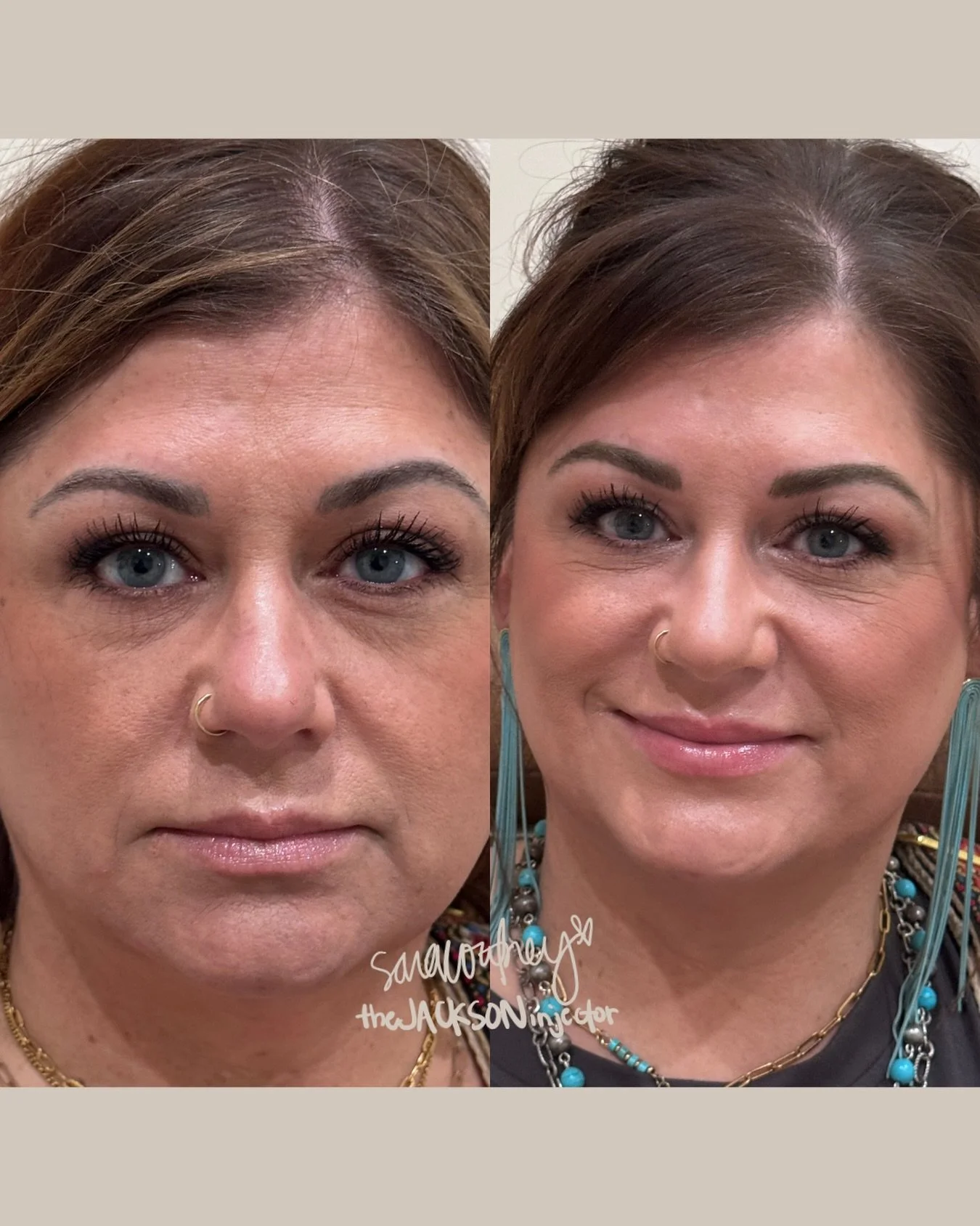 ooooookay but THIS is why we love biostimulators. 👏🏼

Sculptra works gradually by stimulating your own collagen production, so results build over weeks and continue improving after each session. Most patients need a series (usually 2&ndash;3 treatm
