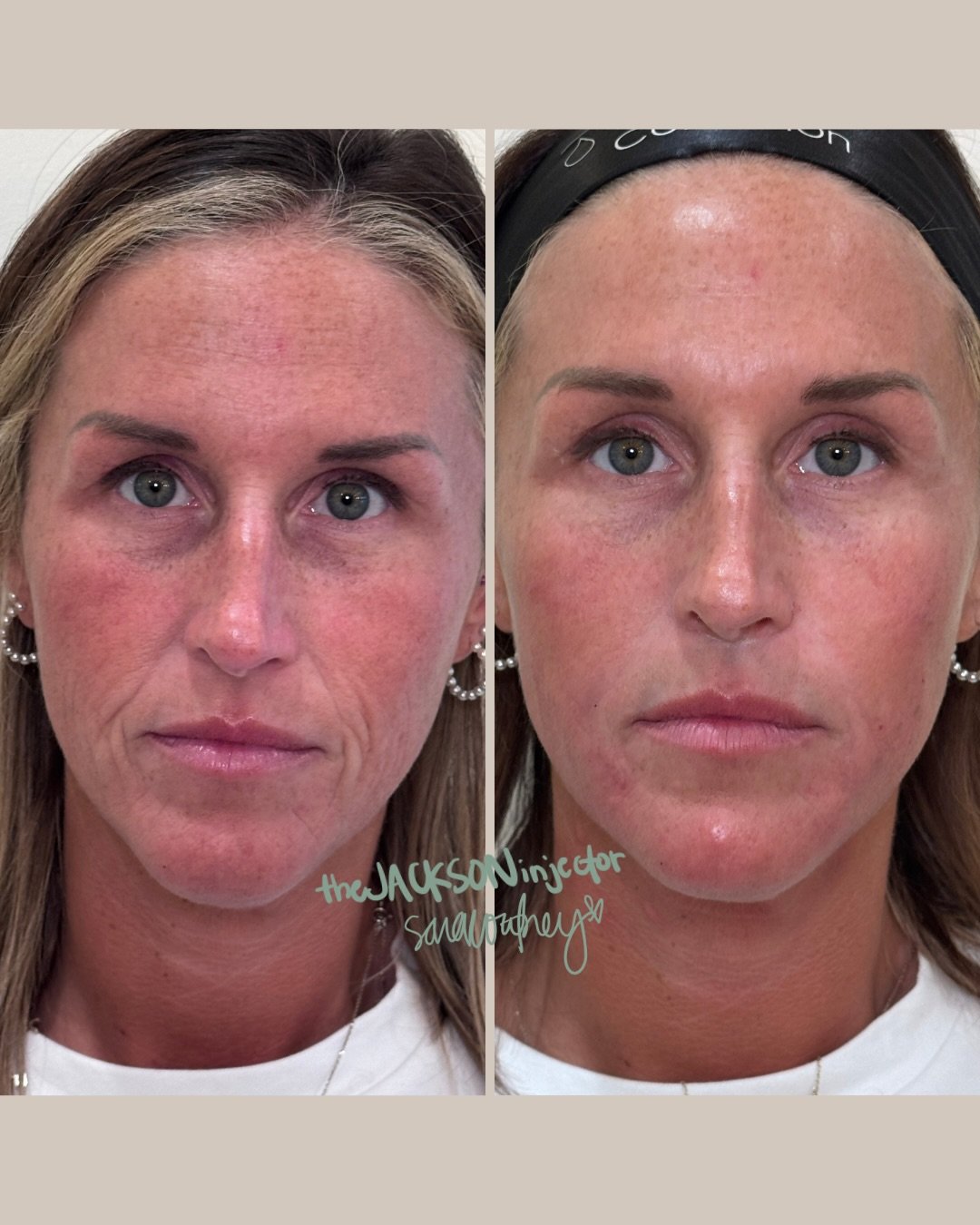 One thing about Highland&hellip; we&rsquo;re always learning.

We recently had David Weir, MSN, APRN, FNP-C (@ultimateskinsource) in the clinic teaching an advanced full facial balancing class. We brought in a live model so everyone could see how an 