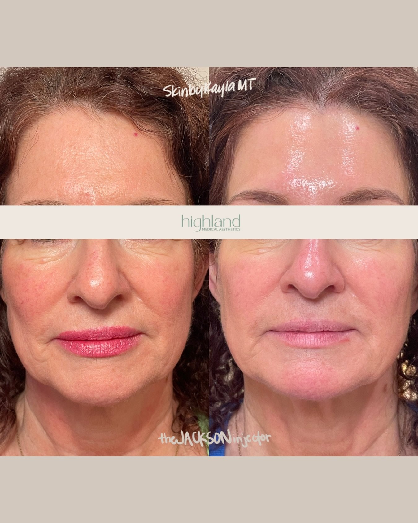 this is what consistency looks like 🤍

quarterly tox, a series of microneedling, sculptra, dermaplaning, and a daily medical-grade skincare routine&mdash;done with intention, not urgency!

her skin is now calmer, more resilient, smoother in texture,