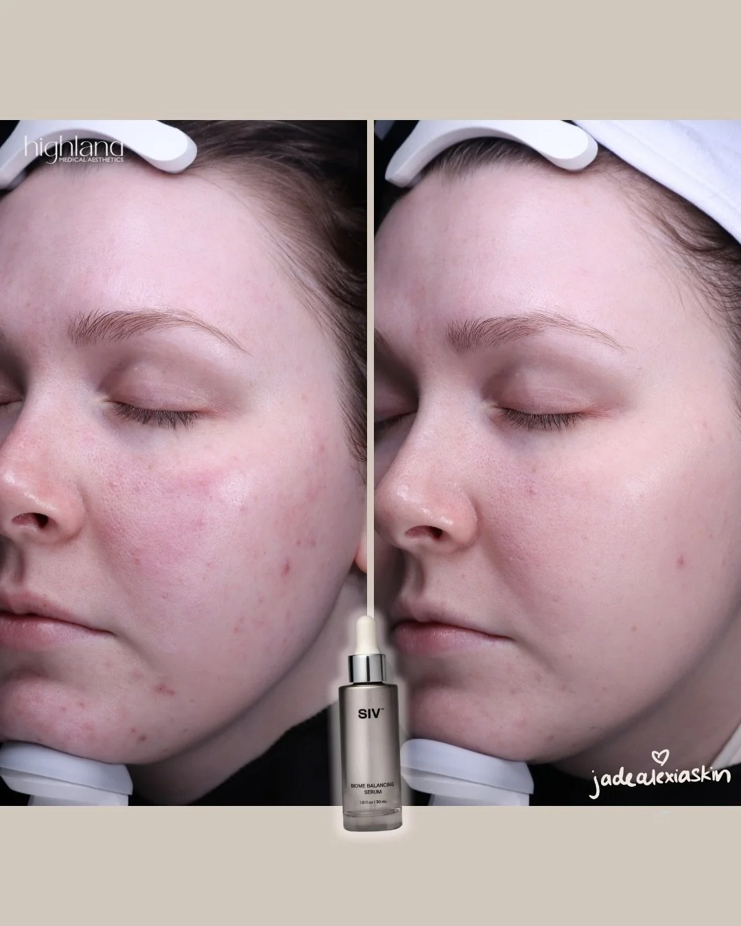 Calmer skin, clearer results.

These VISIA scans after just 1 month on SIV Biome Balancing Serum show reduced redness, more even tone, and a healthier barrier&mdash;without overdoing it.

And we&rsquo;re just getting started&hellip; there&rsquo;s mor