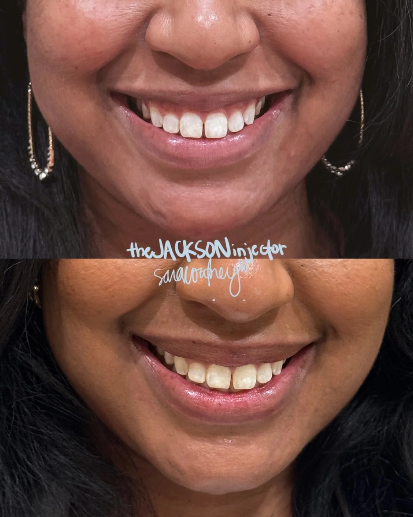 A softer, more balanced smile&mdash; while still looking completely natural 🤍

This lip flip gently relaxes the upper lip to reduce gum show and enhance your natural shape&hellip; no filler needed.

Subtle, effortless, and still you ✨
Book here ↴
📞