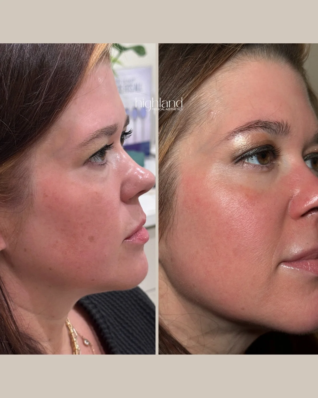 Pigment doesn&rsquo;t just &ldquo;fade&rdquo;&hellip; it has to be treated correctly 👀

This is what happens when we target discoloration the right way&mdash; consistent skincare, intentional treatments, and a plan that actually makes sense for your