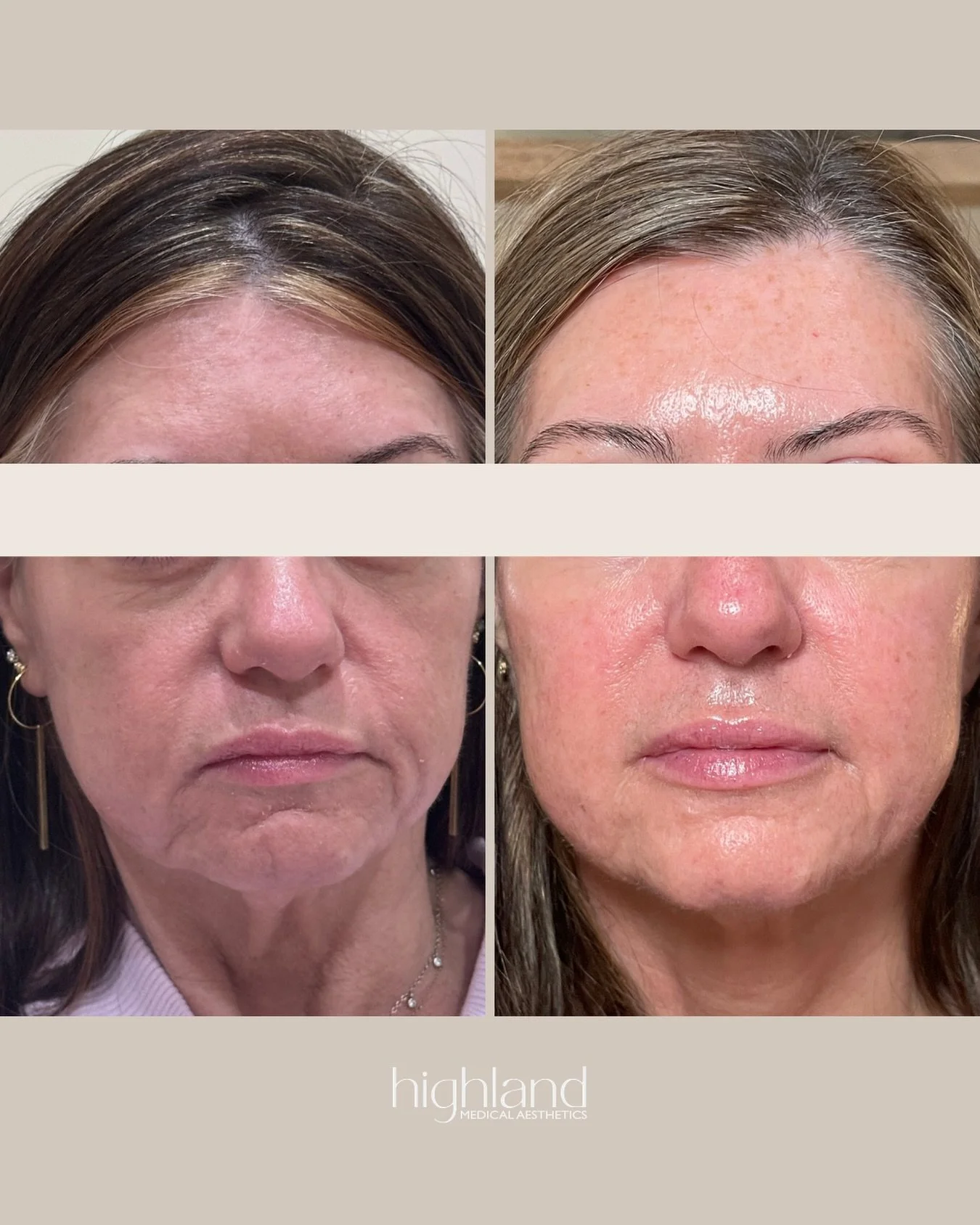 One year with highland.

This is what happens when you trust the plan, stay consistent, and let us do what we do best! 

We focus on the long game&mdash;building healthier skin, restoring structure, and creating results that actually last&hellip; not