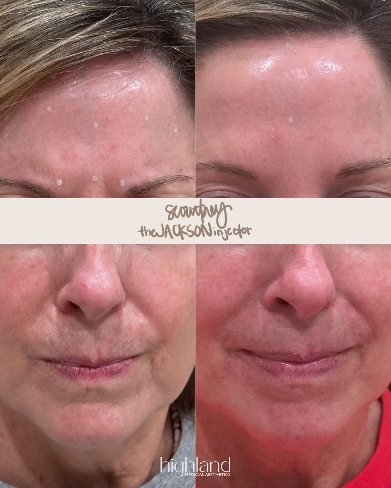 guess what we did 👀 

subtle enough that no one notices, but everyone asks what you&rsquo;re doing for your skin.

🏥 @highlandmedms | Flowood, MS 
📱 Text 601-521-9731 | Call 601-439-2436
💻 Use the link in bio to book online