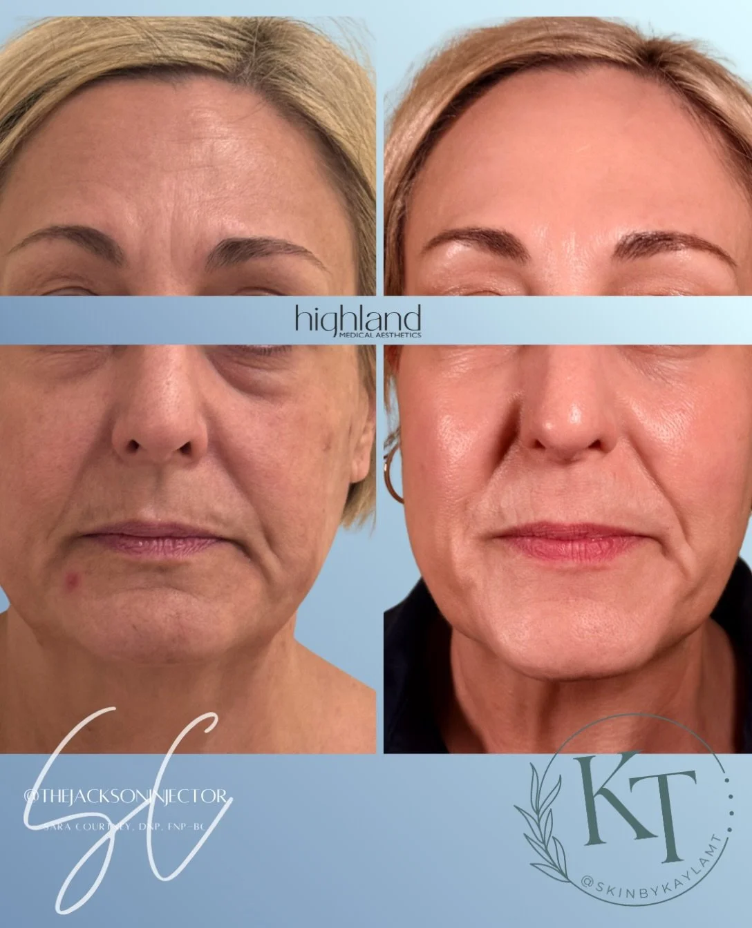 This is your sign to stop chasing individual wrinkles.

it wasn&rsquo;t just the forehead
or the smile lines, 

When we zoom out and treat the face as a whole instead of one area at a time, the result is softer, more balanced, and far more natural.

