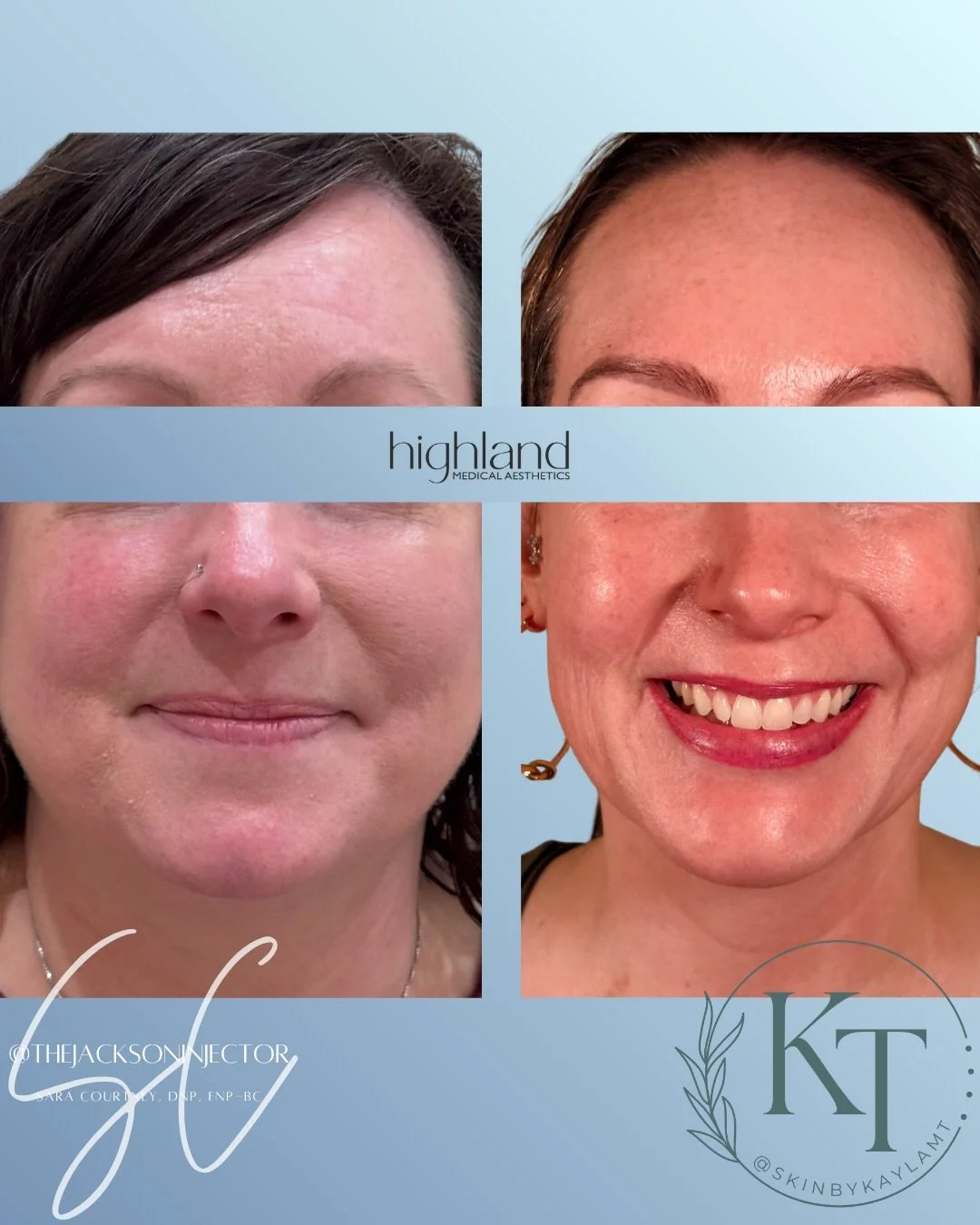 Proof that the best results don&rsquo;t always come from doing one thing. 👏🏼

This transformation was a team effort &mdash; combining facial balancing + a customized skincare plan to improve the face as a whole.

Because you can add volume in all t