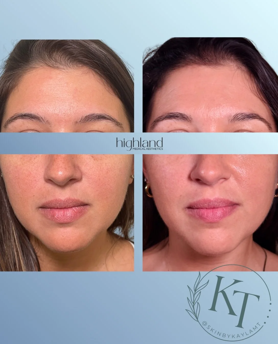 The kind of before + after we love 👏🏼

Healthier-looking skin, more even tone, softened redness + an overall glow that still looks completely like her. ✨

Good skincare isn&rsquo;t about changing your face&mdash;it&rsquo;s about getting your skin t