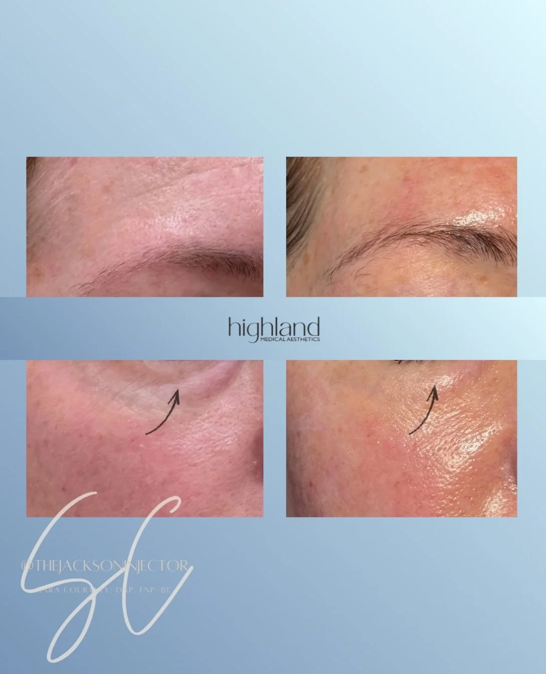 The kind of filler where no one knows you got filler. 👏🏼

As we age, we naturally lose collagen and support in the under-eye area, which can create a more tired appearance&mdash;even when you&rsquo;re anything but tired.

A small amount of strategi