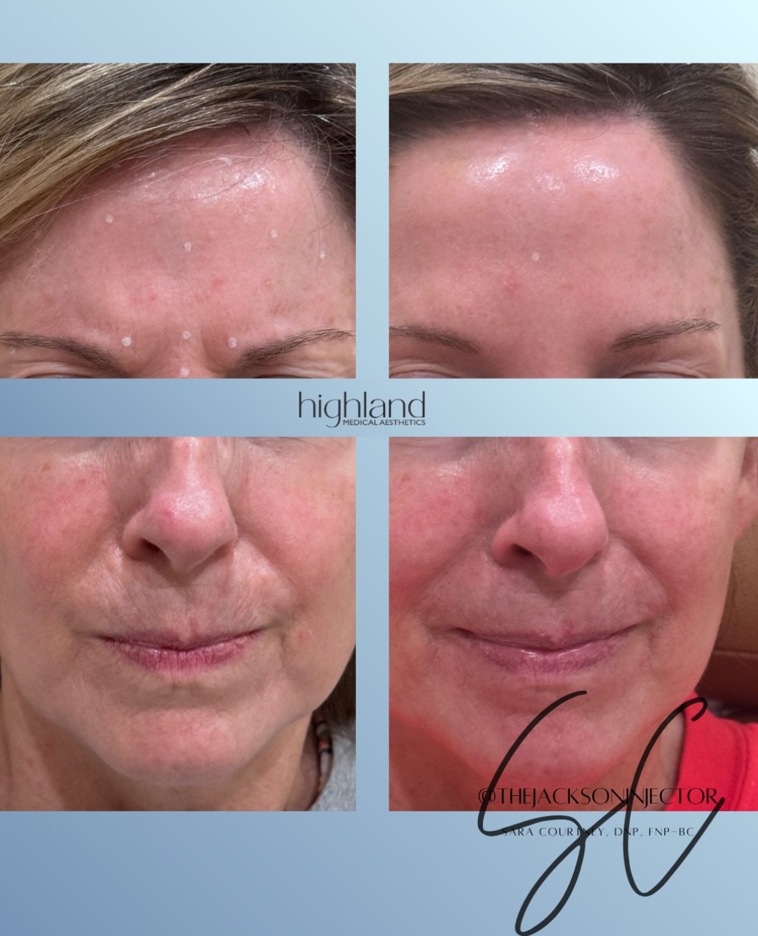 The holidays are coming&hellip; is your tox ready? 🎄✨

Between holiday parties, family photos, and all the festivities, the last thing you want to worry about is those forehead lines making an appearance. 😉

A little tox can go a long way in soften