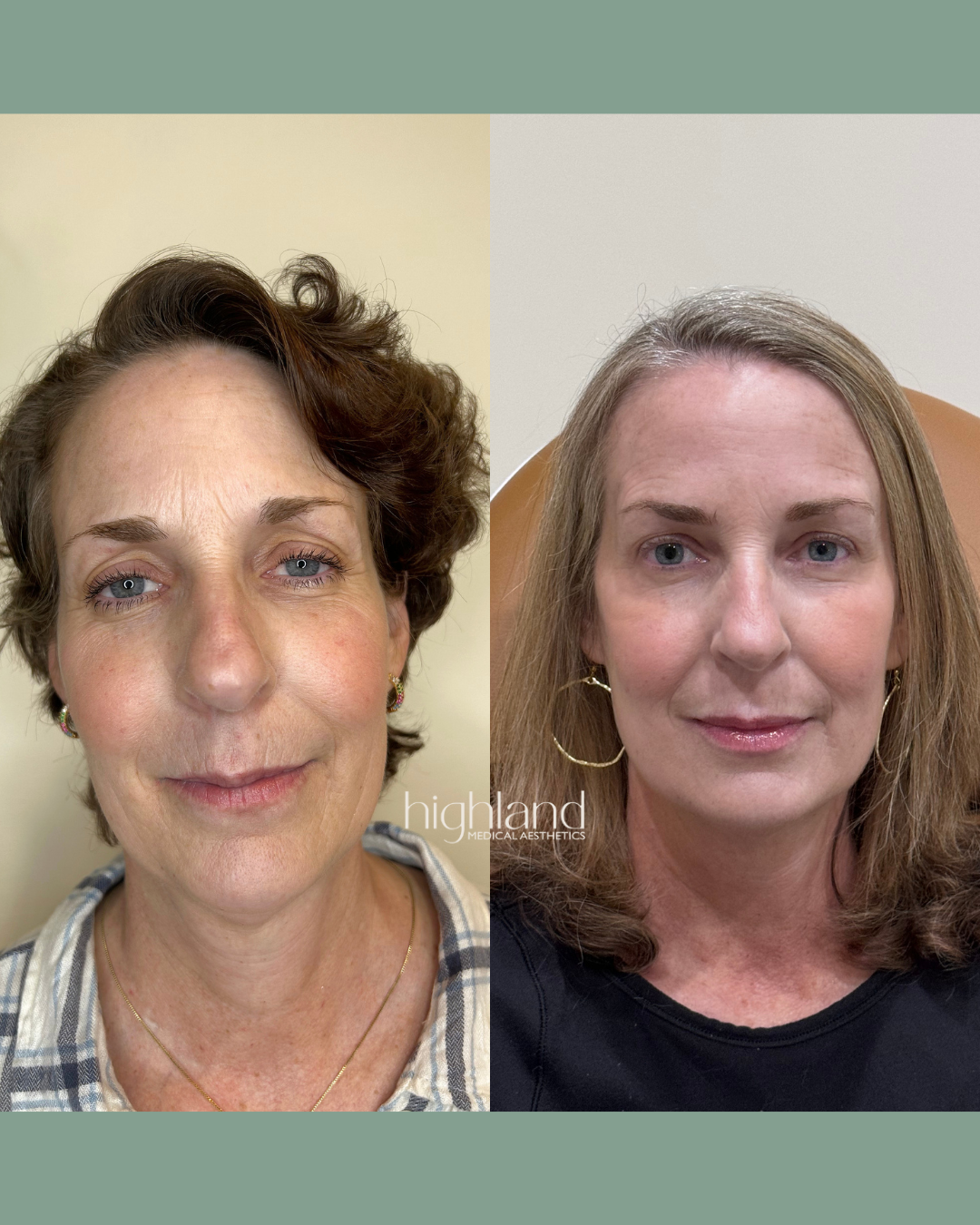 morpheus8 before and after