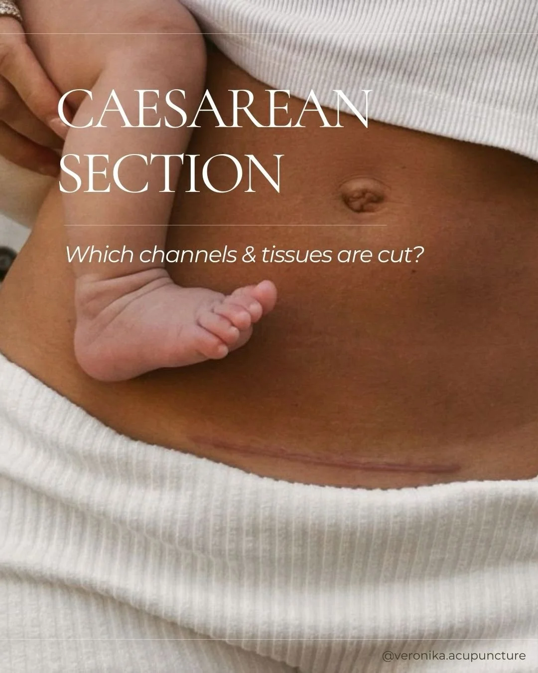 CAESAREAN SECTION SCARS 🤍
From a TCM perspective, a c-section cuts through four vital channels &mdash; disrupting the very pathways we rely on to recover, nourish our babies, and bond with them after birth.
🪷 Ren Mai (Conception Vessel) &mdash; gov