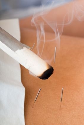 warming moxibustion and acupuncture treatment