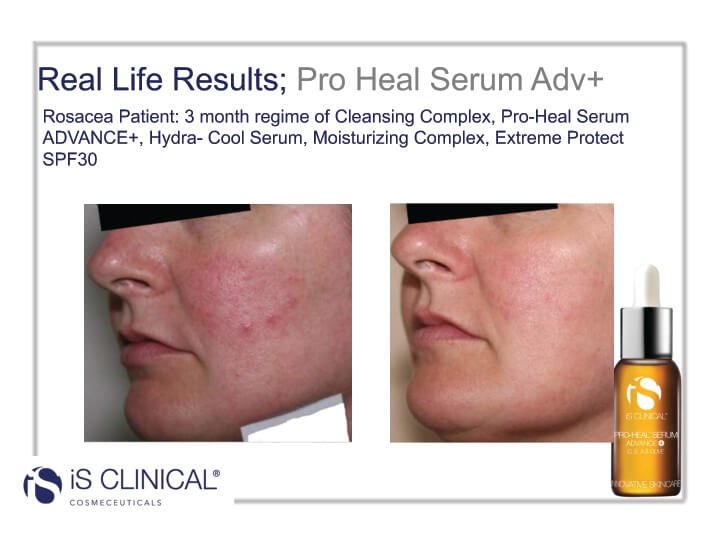 proheal_before_after_image2.jpg