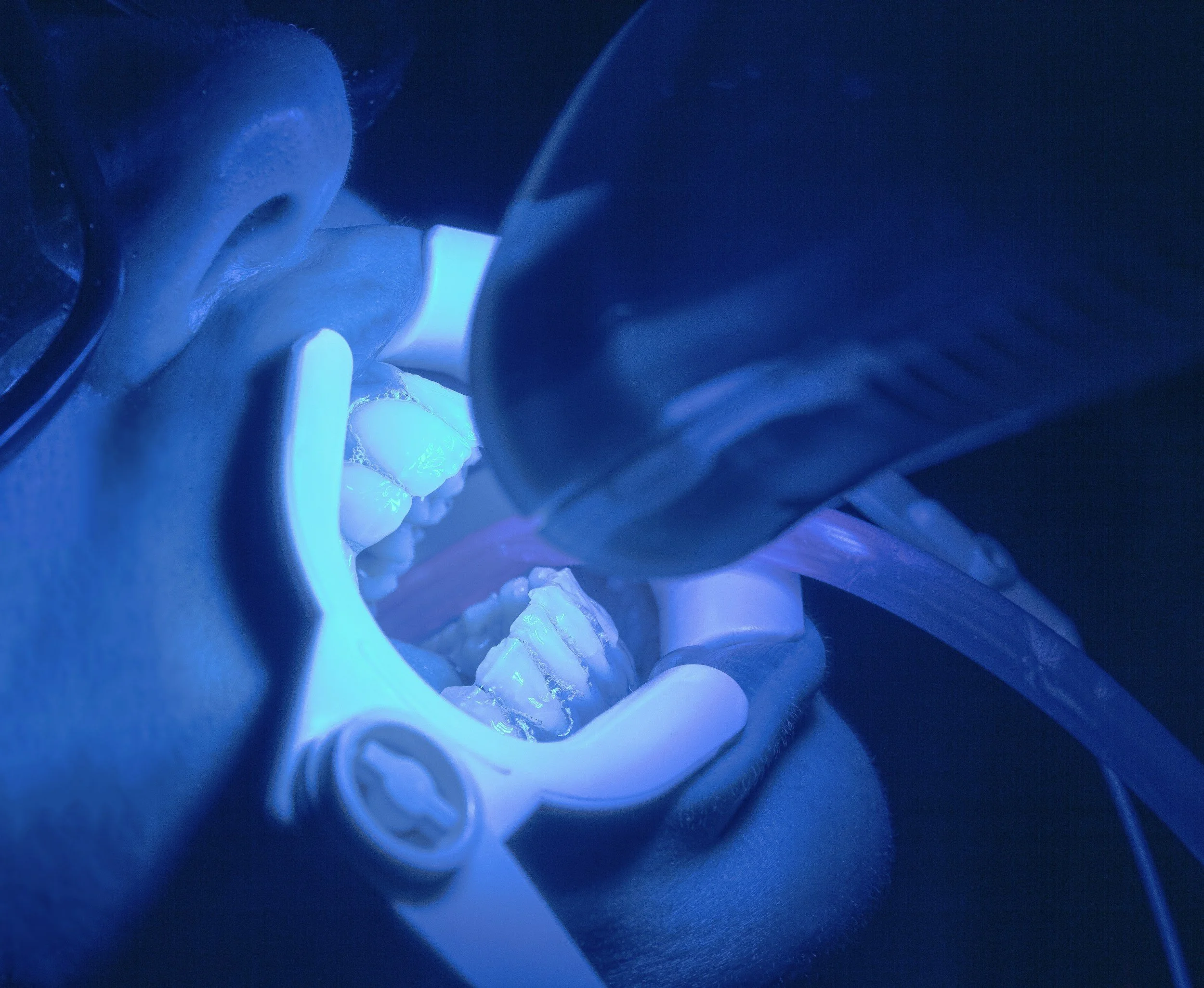 Close-up of a person receiving dental treatment with a dental curing light illuminating their teeth in blue.